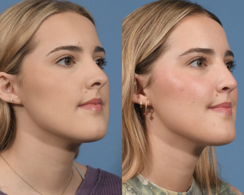 Rhinoplasty Before & After #26 image 2