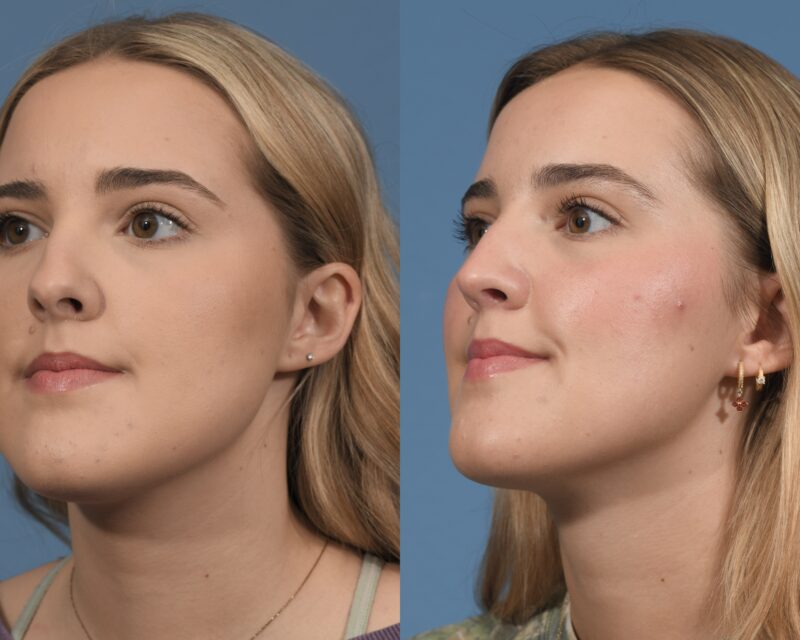 Rhinoplasty Before & After #26 image 3