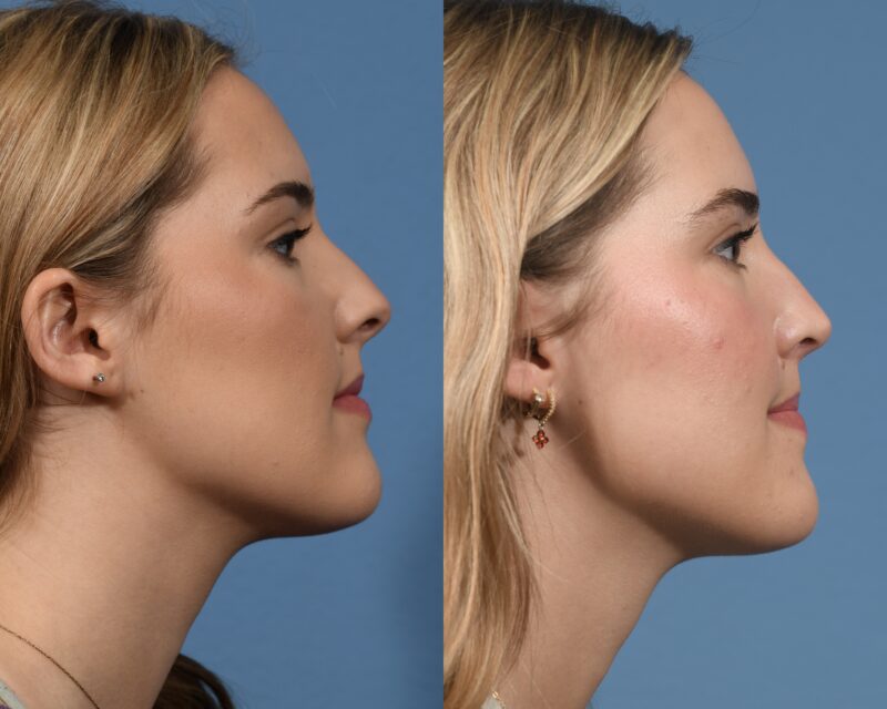 Rhinoplasty Before & After #26 image 4
