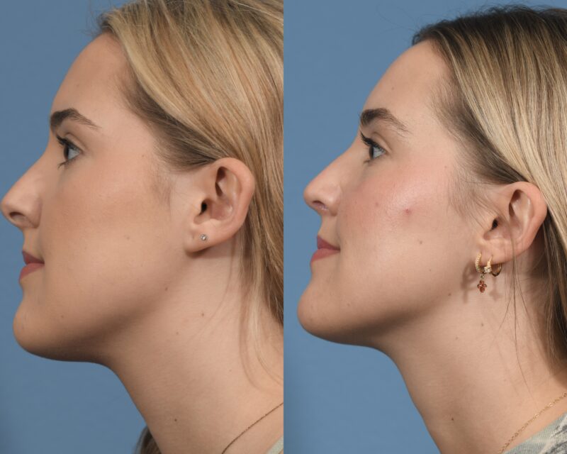 Rhinoplasty Before & After #26 image 5