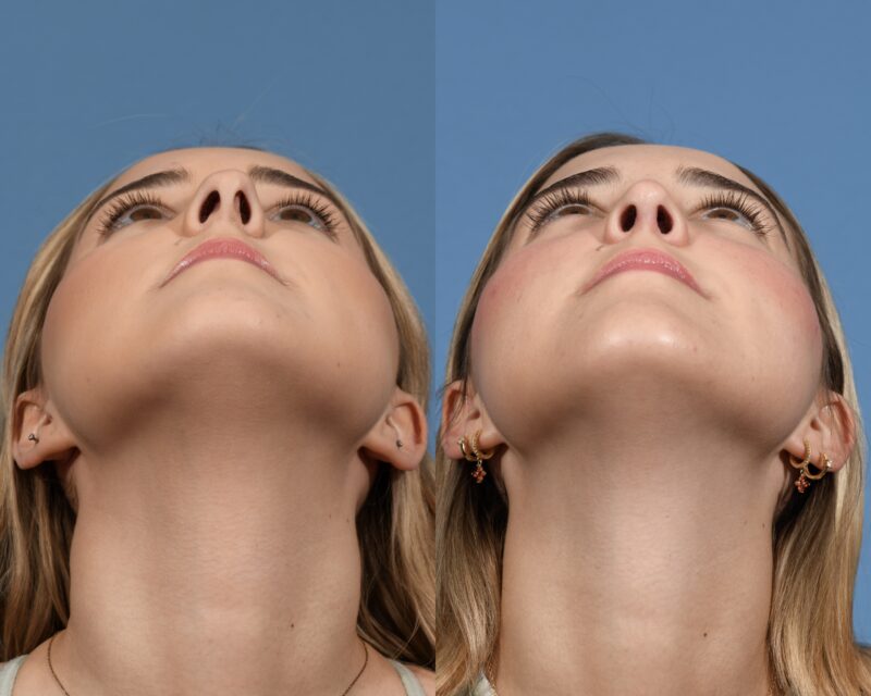 Rhinoplasty Before & After #26 image 6