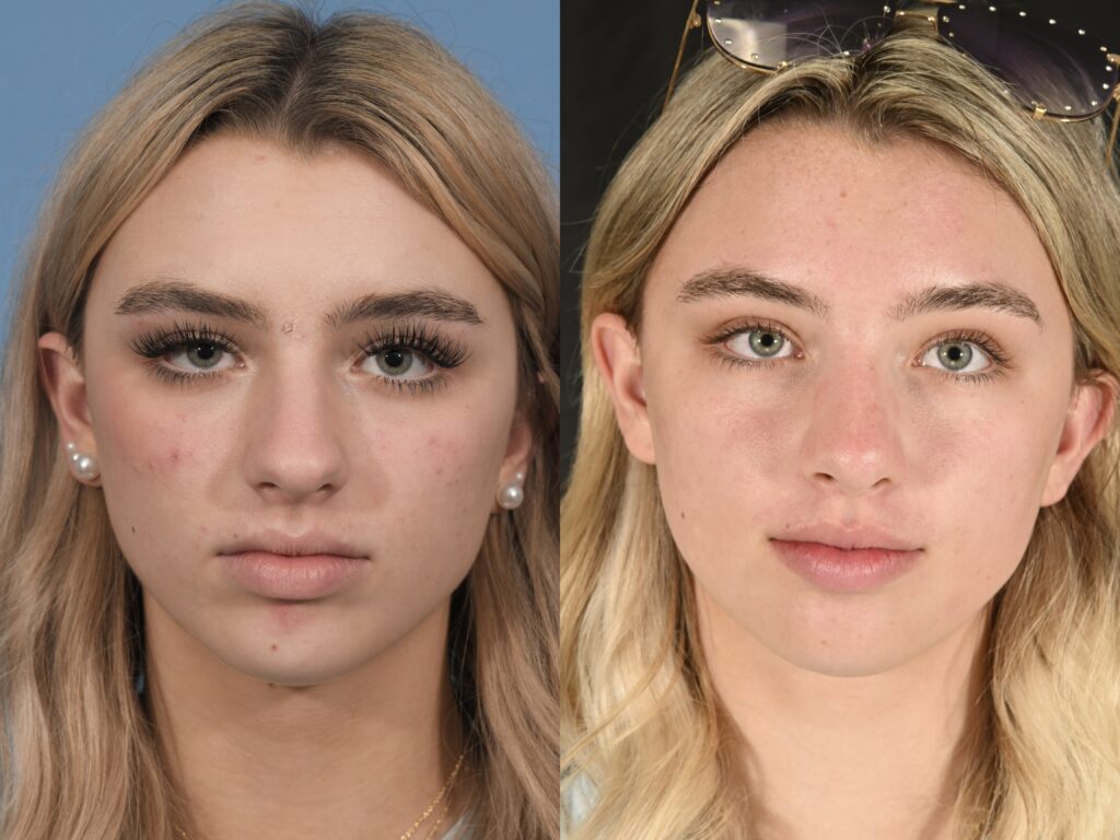 Preservation Rhinoplasty Before & After #20 before and after