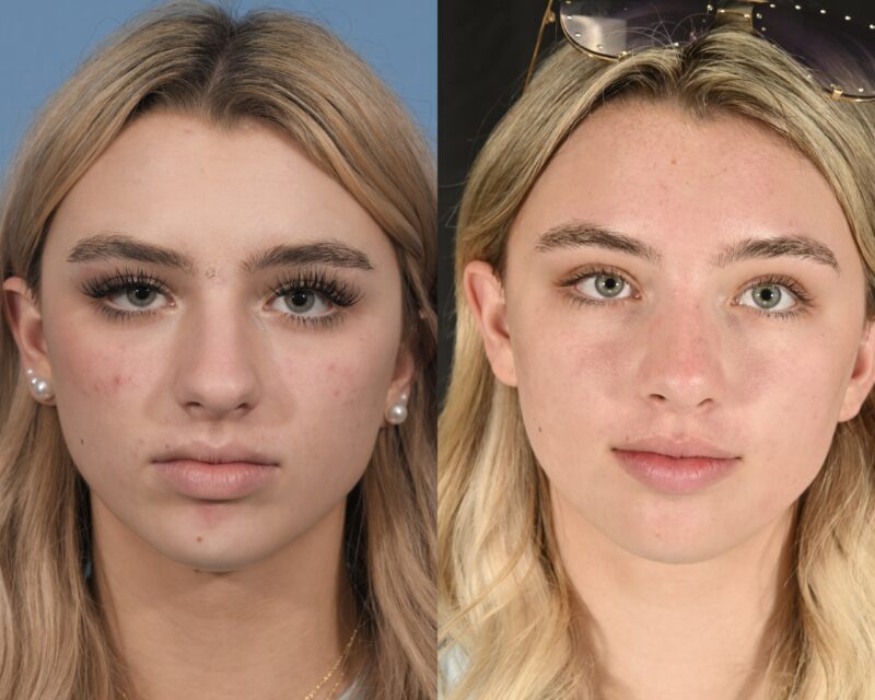 Preservation Rhinoplasty Before & After #20