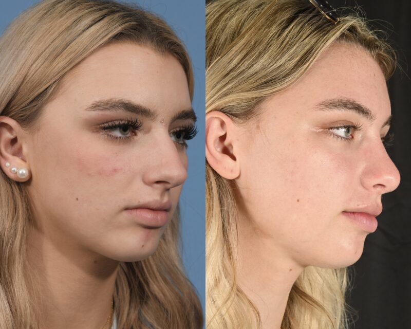 Preservation Rhinoplasty Before & After #20 image 2