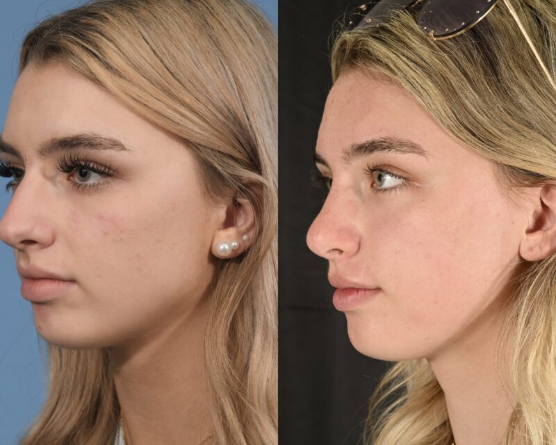 Preservation Rhinoplasty Before & After #20 image 3