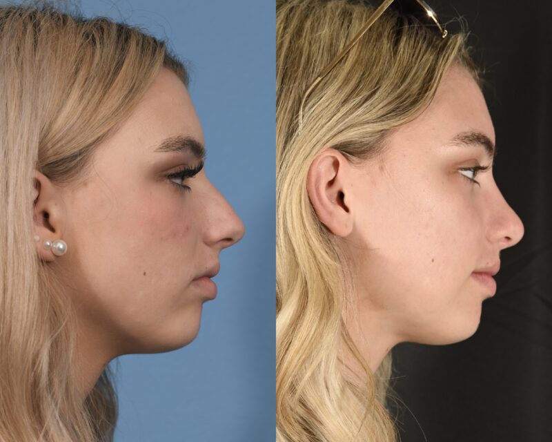 Preservation Rhinoplasty Before & After #20 image 4