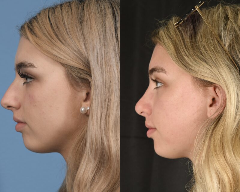 Preservation Rhinoplasty Before & After #20 image 5