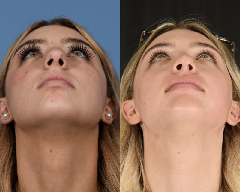 Preservation Rhinoplasty Before & After #20 image 6