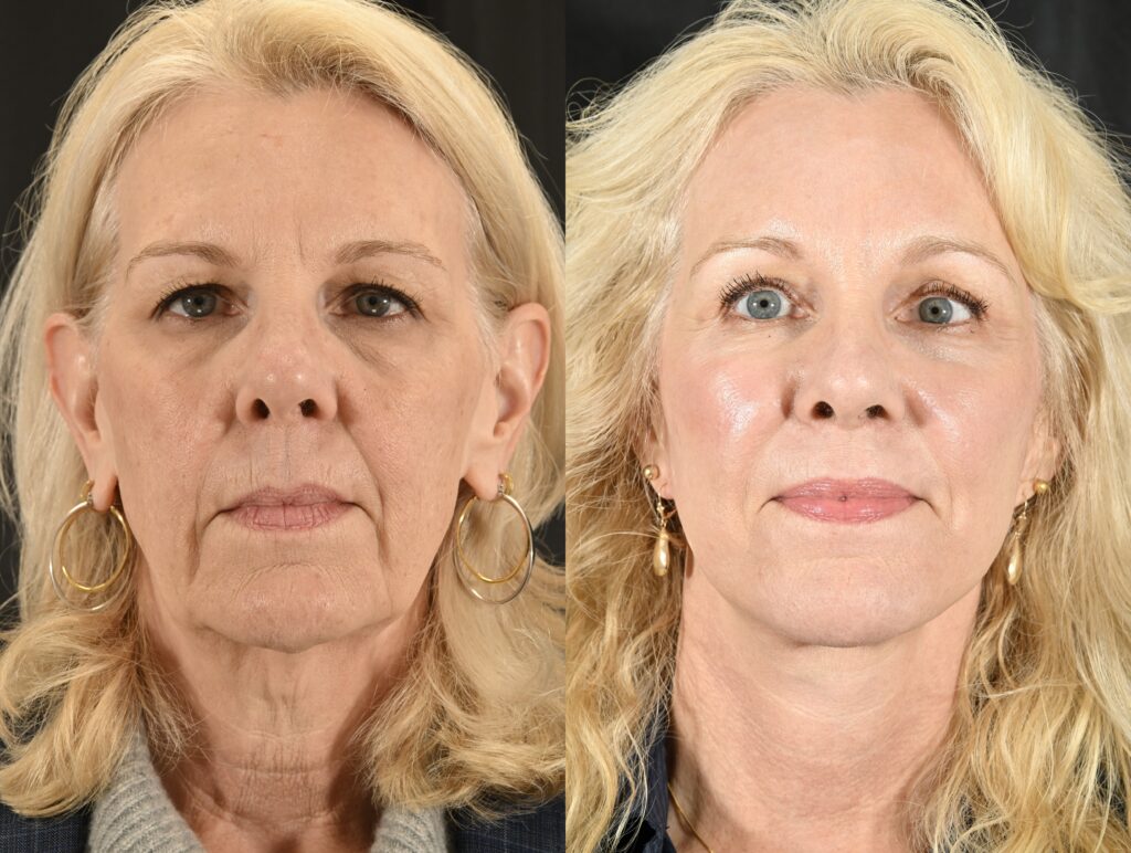 Facelift Before & After #4 before and after