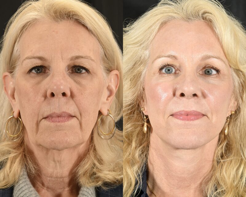 Facelift Before & After #4