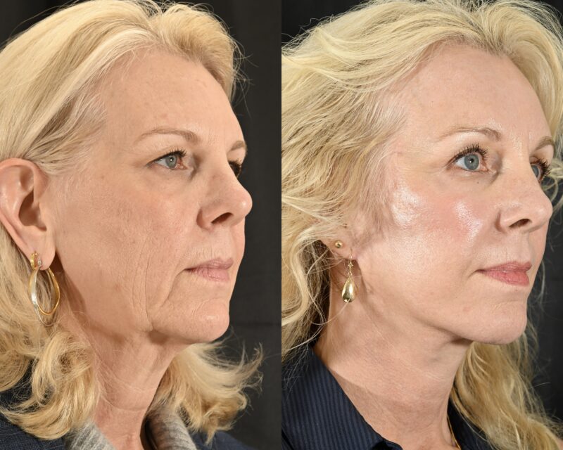 Facelift Before & After #4 image 2