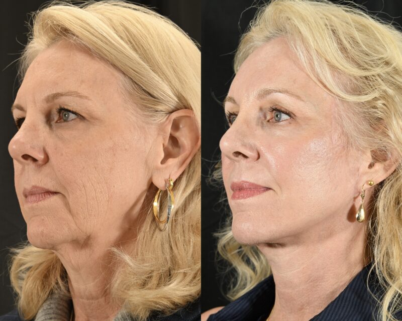 Facelift Before & After #4 image 3