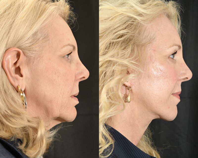 Facelift Before & After #4 image 4