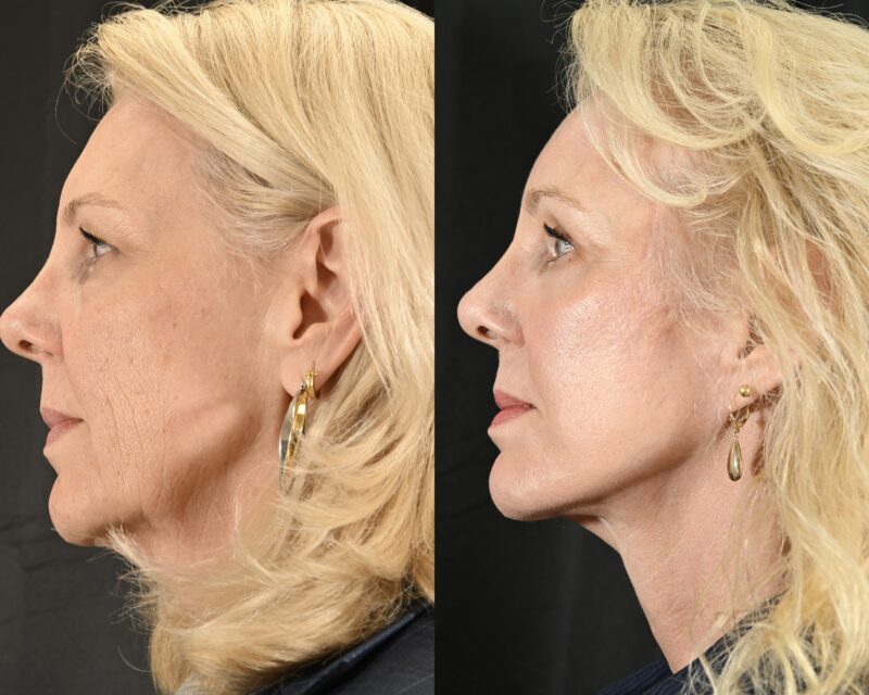 Facelift Before & After #4 image 5