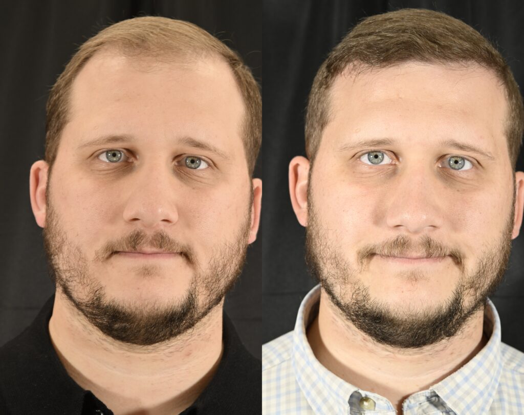 Hair Transplant Before & After #10 before and after