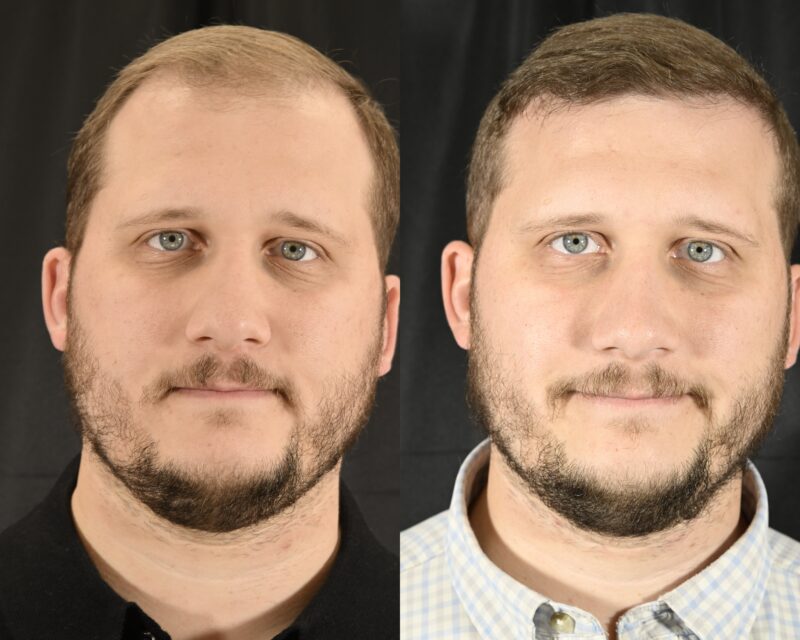 Hair Transplant Before & After #10