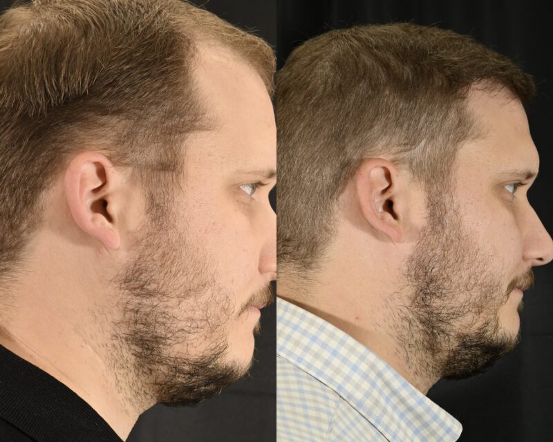 Hair Transplant Before & After #10 image 2