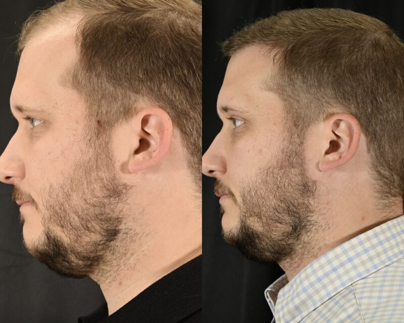 Hair Transplant Before & After #10 image 3