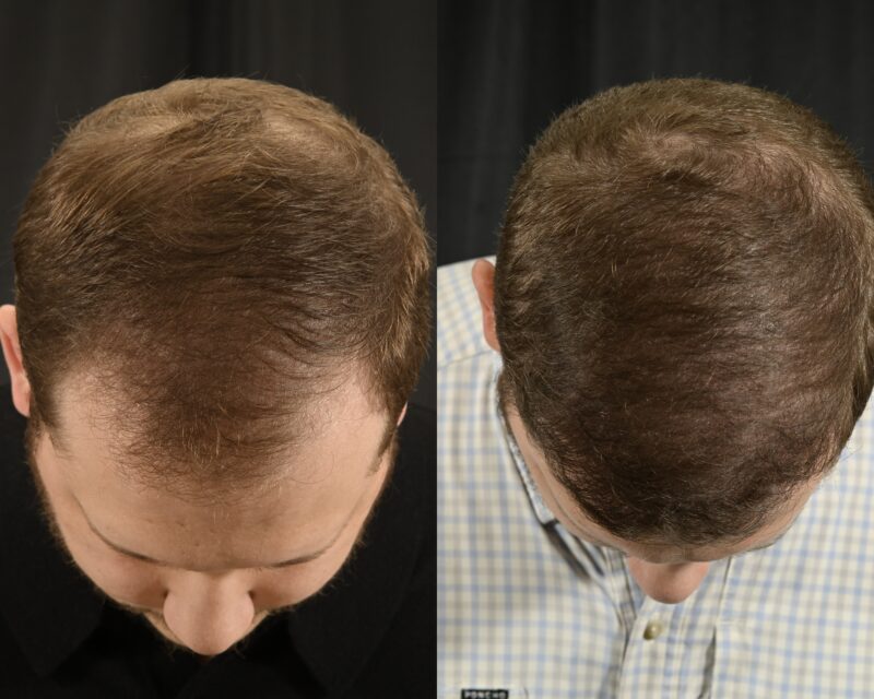 Hair Transplant Before & After #10 image 4