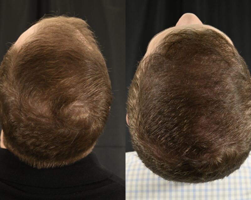 Hair Transplant Before & After #10 image 5