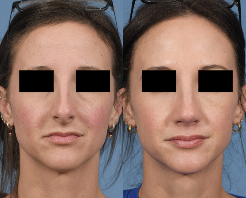 Rhinoplasty Before & After #24 before and after