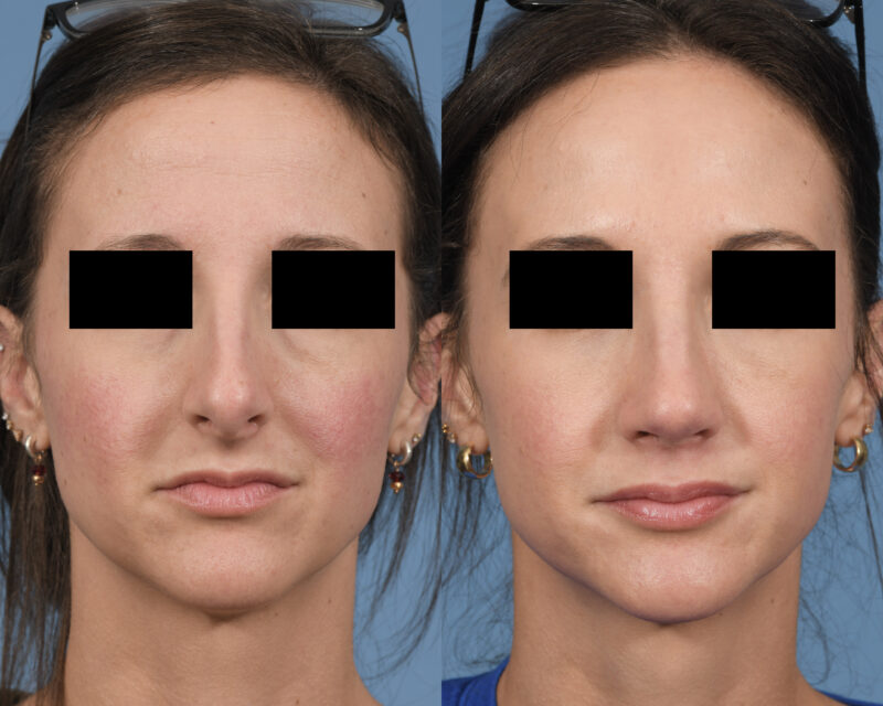 Rhinoplasty Before & After #24