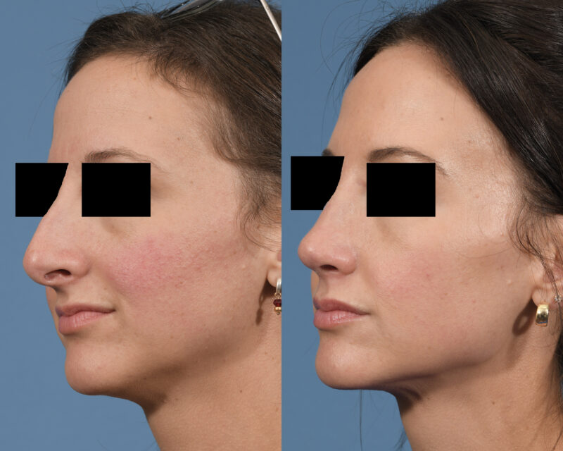 Rhinoplasty Before & After #24 image 2