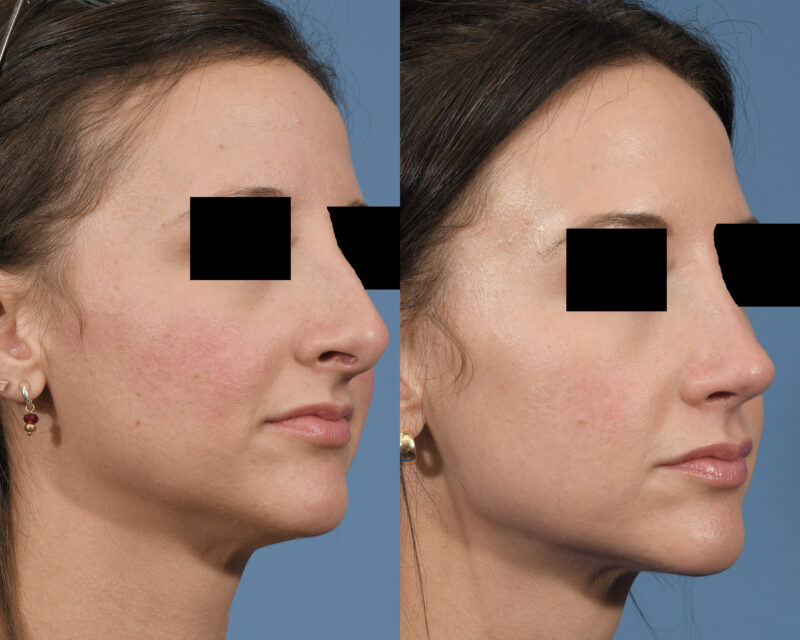 Rhinoplasty Before & After #24 image 3