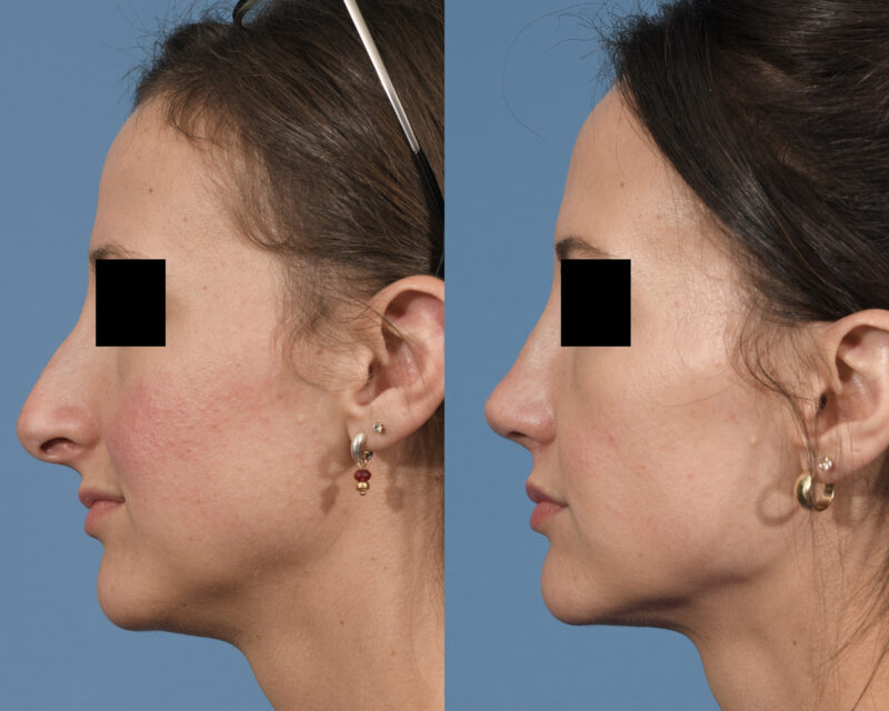 Rhinoplasty Before & After #24 image 4