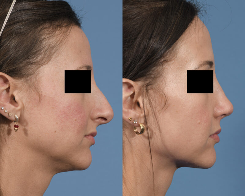 Rhinoplasty Before & After #24 image 5