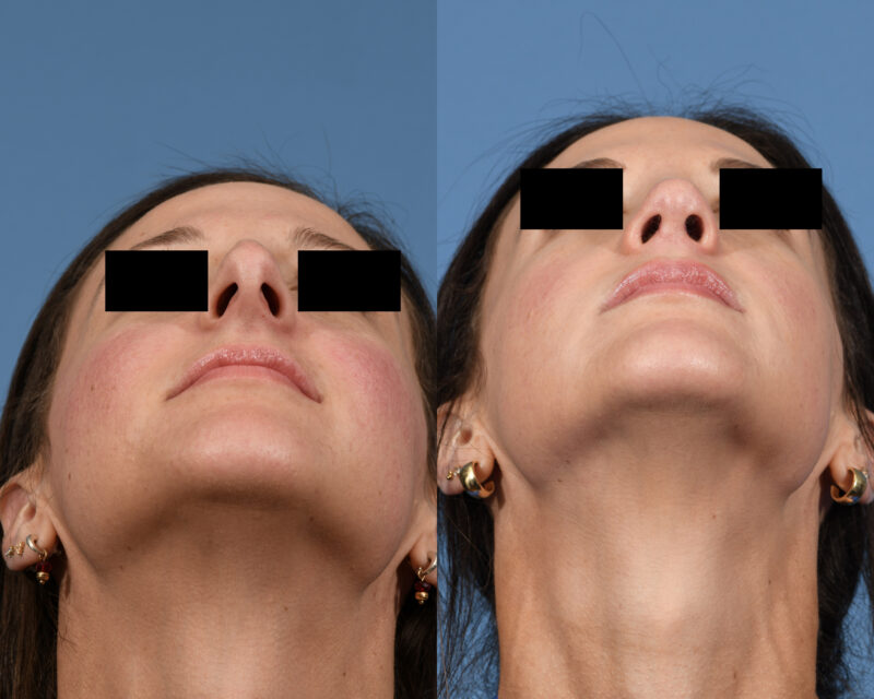 Rhinoplasty Before & After #24 image 6